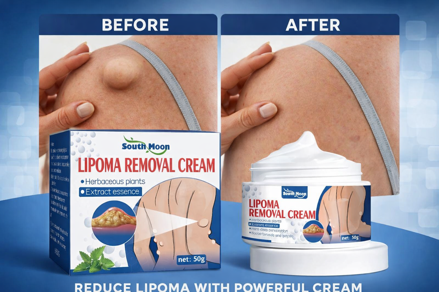 Lipoma Removal Cream - IMPORTED