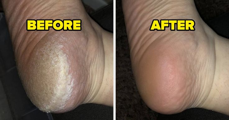 Rechargeable Electric Foot Callus Remover ( Imported)